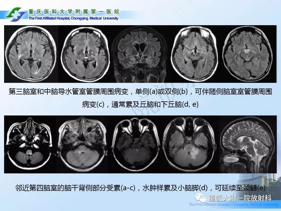 影像PPT - 【PPT】视神经脊髓炎临床及MRI特征-24