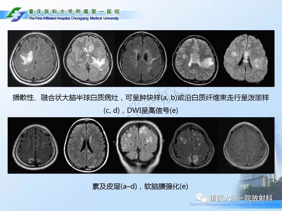 影像PPT - 【PPT】视神经脊髓炎临床及MRI特征-26
