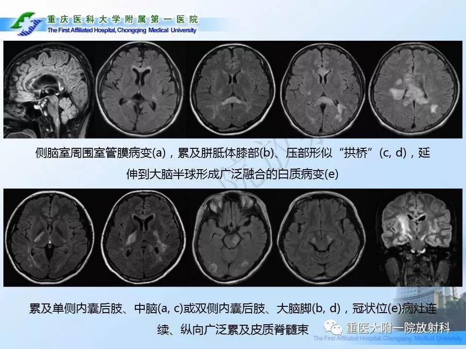 影像PPT - 【PPT】视神经脊髓炎临床及MRI特征-25