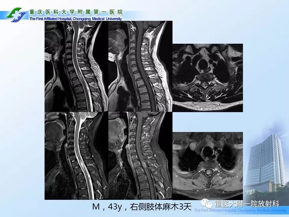 影像PPT - 【PPT】视神经脊髓炎临床及MRI特征-30
