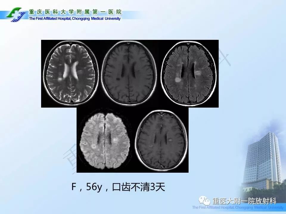 影像PPT - 【PPT】视神经脊髓炎临床及MRI特征-31