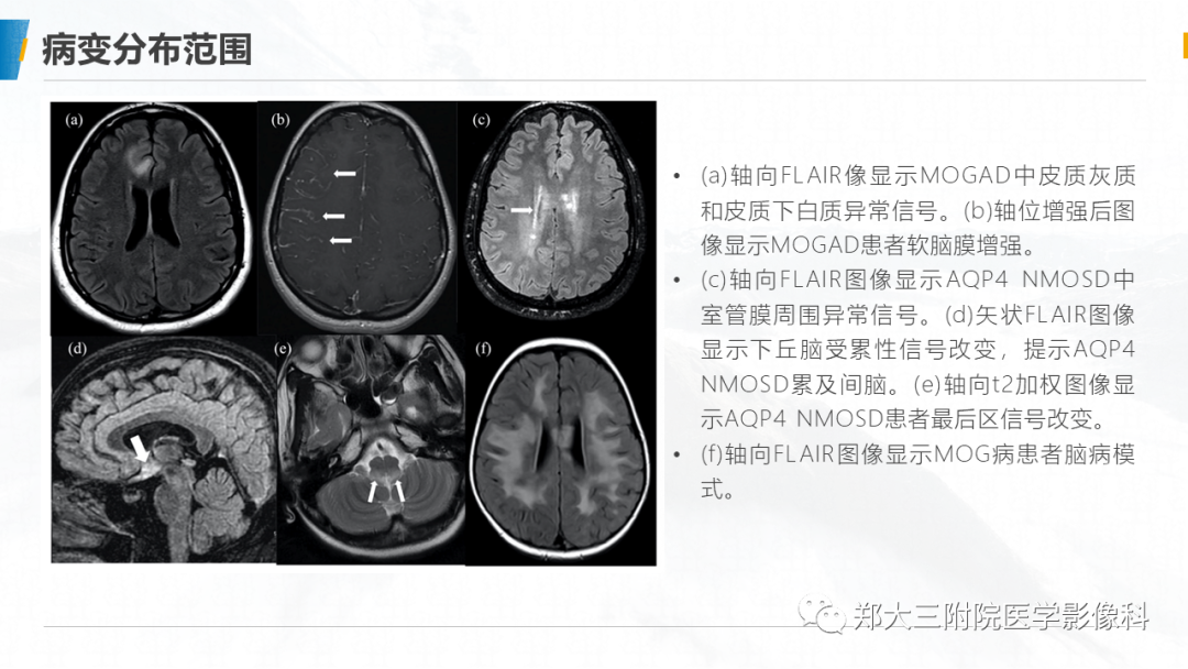 影像PPT - 【PPT】MOG抗体相关疾病-16