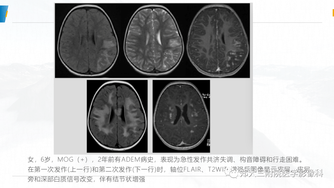影像PPT - 【PPT】MOG抗体相关疾病-17