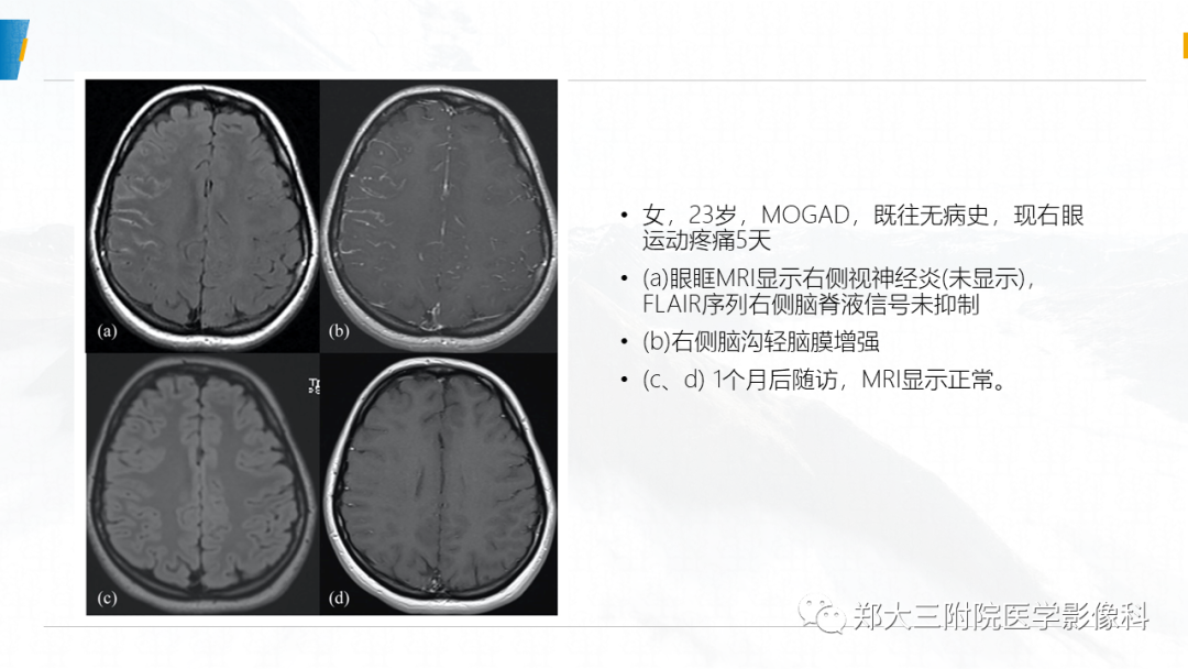 影像PPT - 【PPT】MOG抗体相关疾病-18