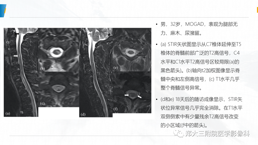 影像PPT - 【PPT】MOG抗体相关疾病-20