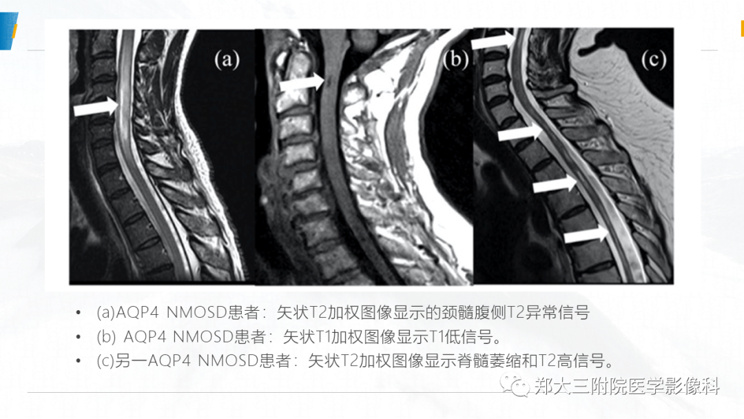 影像PPT - 【PPT】MOG抗体相关疾病-21