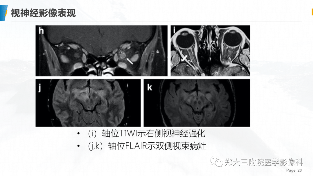 影像PPT - 【PPT】MOG抗体相关疾病-23