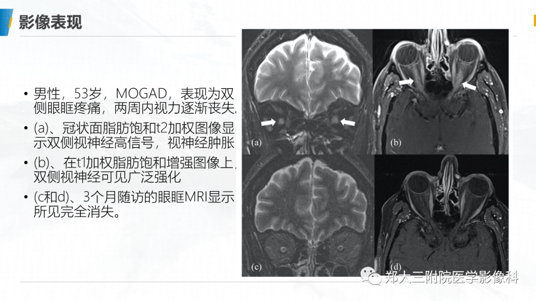 影像PPT - 【PPT】MOG抗体相关疾病-24