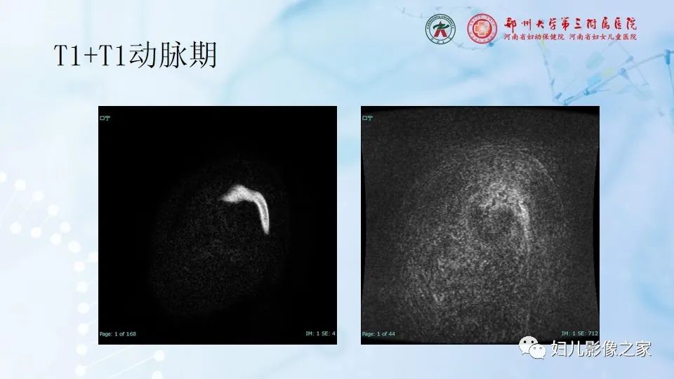 影像PPT - 【病例】幕上毛细胞型星形细胞瘤1例MR-7