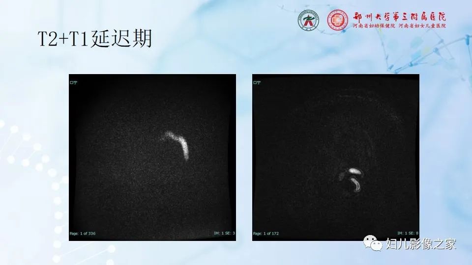 影像PPT - 【病例】幕上毛细胞型星形细胞瘤1例MR-8