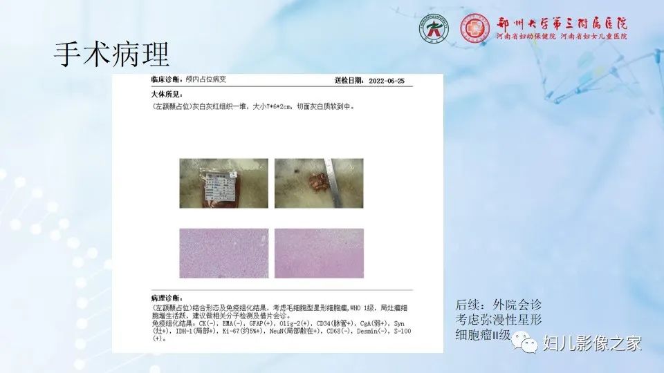影像PPT - 【病例】幕上毛细胞型星形细胞瘤1例MR-11