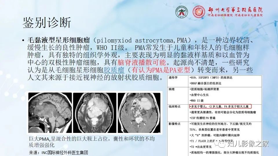 影像PPT - 【病例】幕上毛细胞型星形细胞瘤1例MR-21