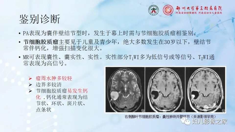 影像PPT - 【病例】幕上毛细胞型星形细胞瘤1例MR-23