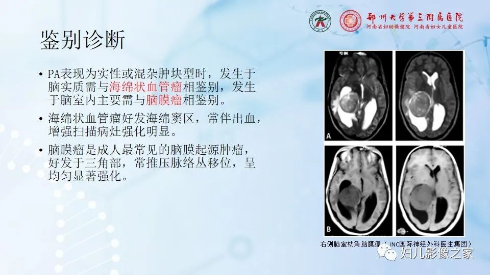 影像PPT - 【病例】幕上毛细胞型星形细胞瘤1例MR-25