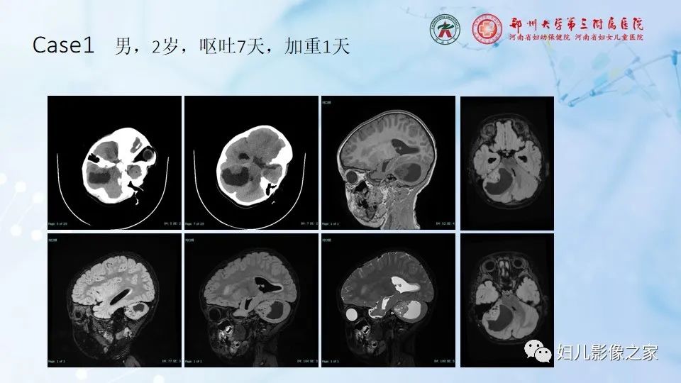 影像PPT - 【病例】幕上毛细胞型星形细胞瘤1例MR-27