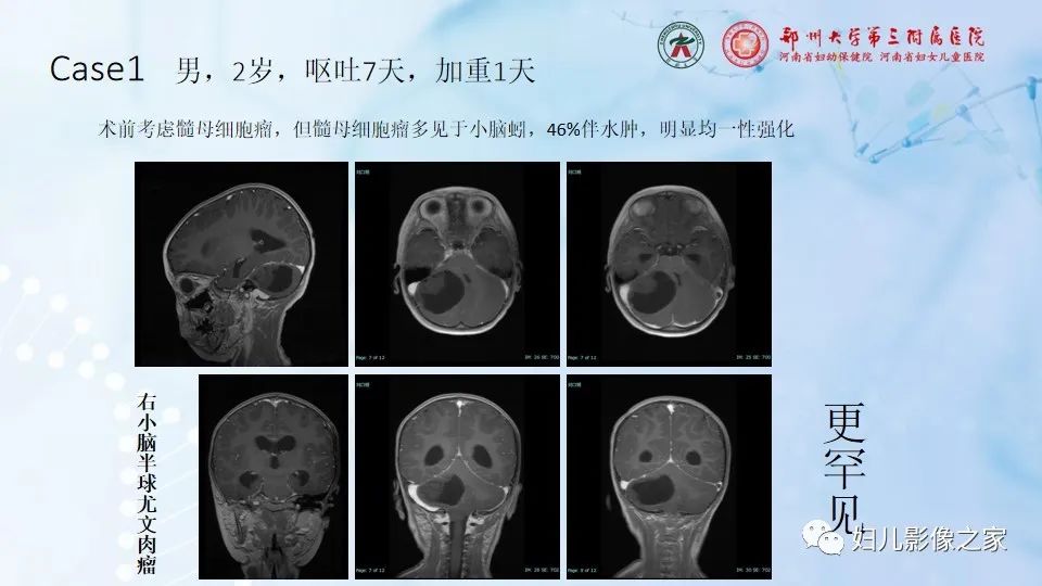 影像PPT - 【病例】幕上毛细胞型星形细胞瘤1例MR-28
