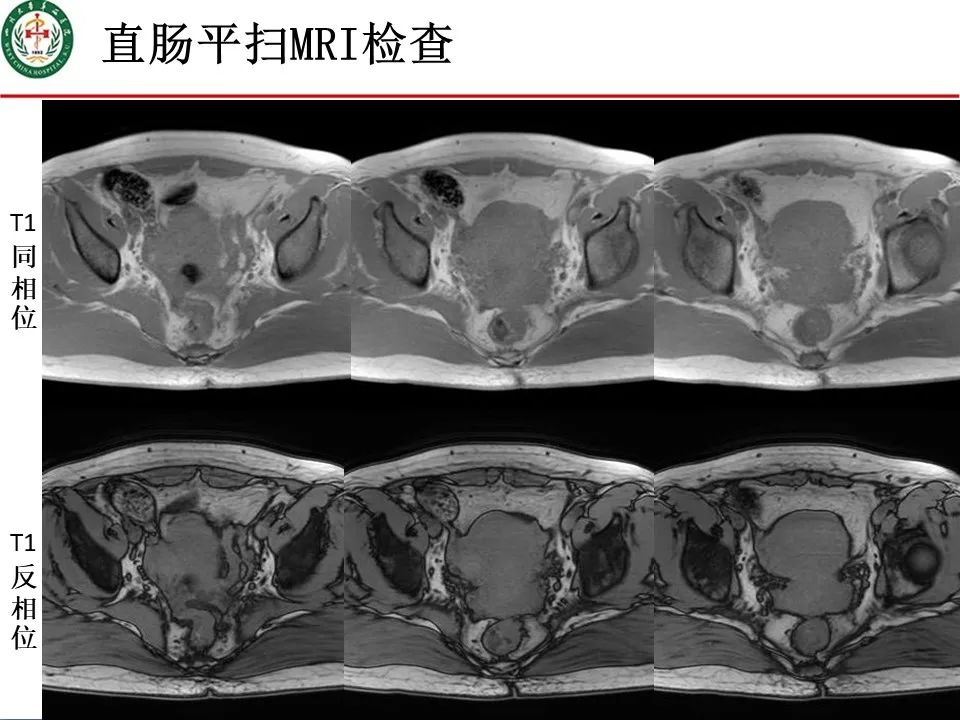影像PPT - 【病例】直肠子宫内膜异位症1例MR影像-3
