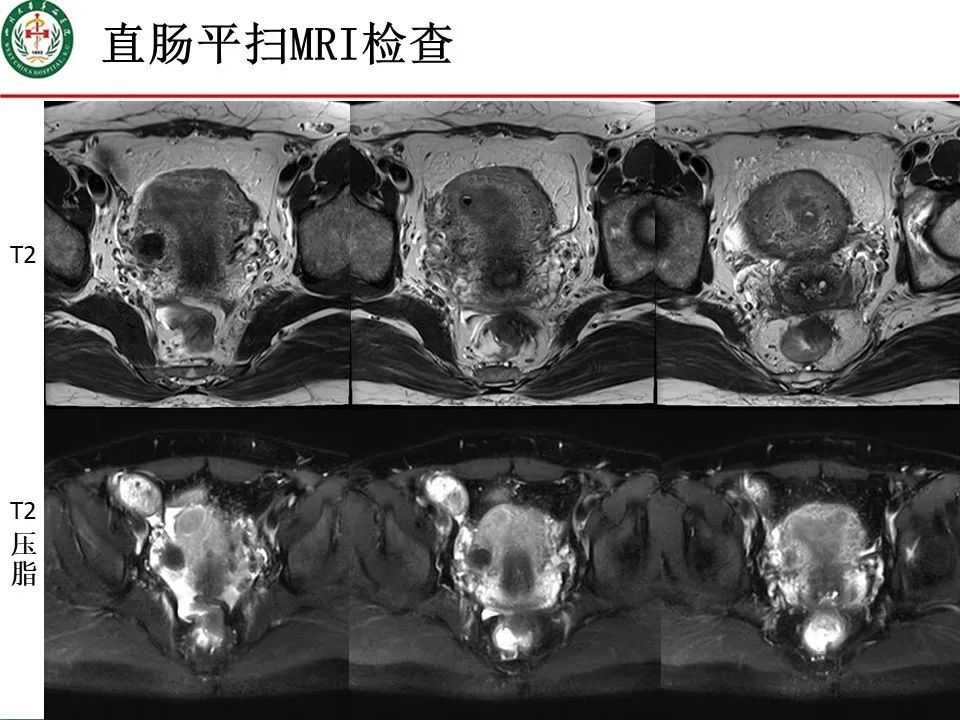 影像PPT - 【病例】直肠子宫内膜异位症1例MR影像-4