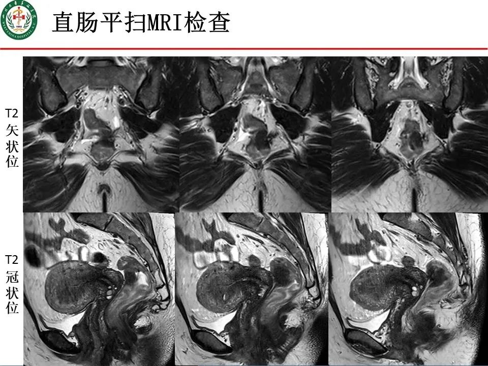 影像PPT - 【病例】直肠子宫内膜异位症1例MR影像-5