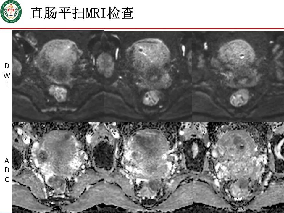 影像PPT - 【病例】直肠子宫内膜异位症1例MR影像-6
