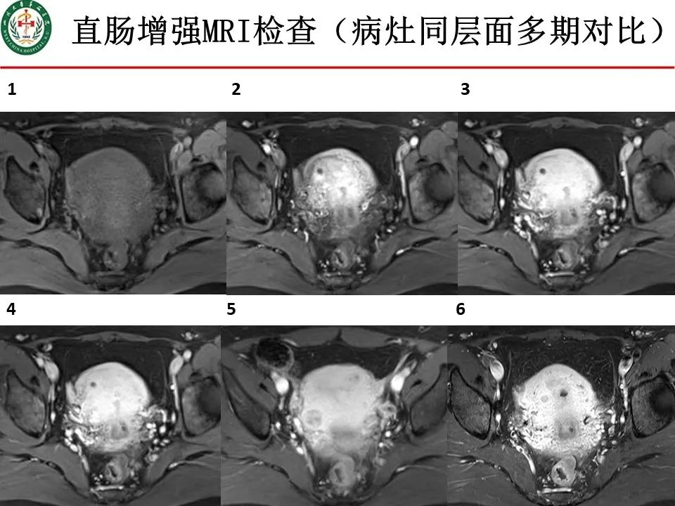 影像PPT - 【病例】直肠子宫内膜异位症1例MR影像-7