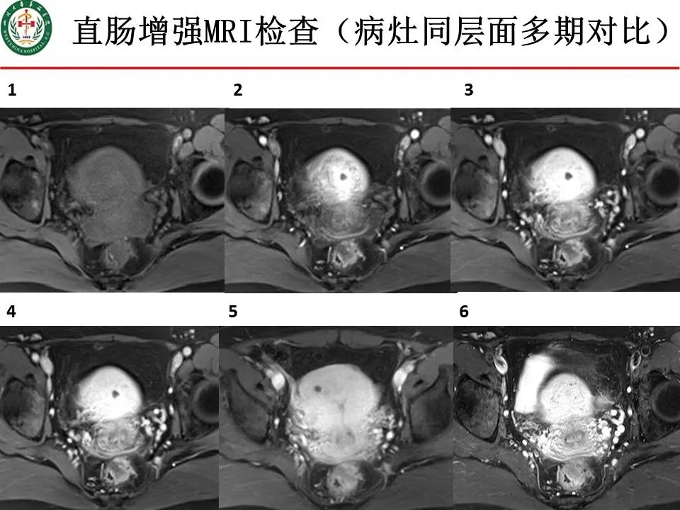 影像PPT - 【病例】直肠子宫内膜异位症1例MR影像-8