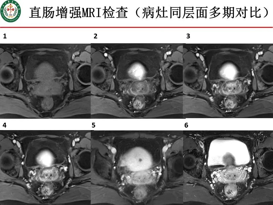 影像PPT - 【病例】直肠子宫内膜异位症1例MR影像-9