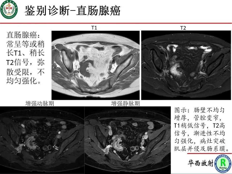 影像PPT - 【病例】直肠子宫内膜异位症1例MR影像-14