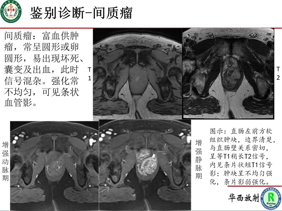 影像PPT - 【病例】直肠子宫内膜异位症1例MR影像-15