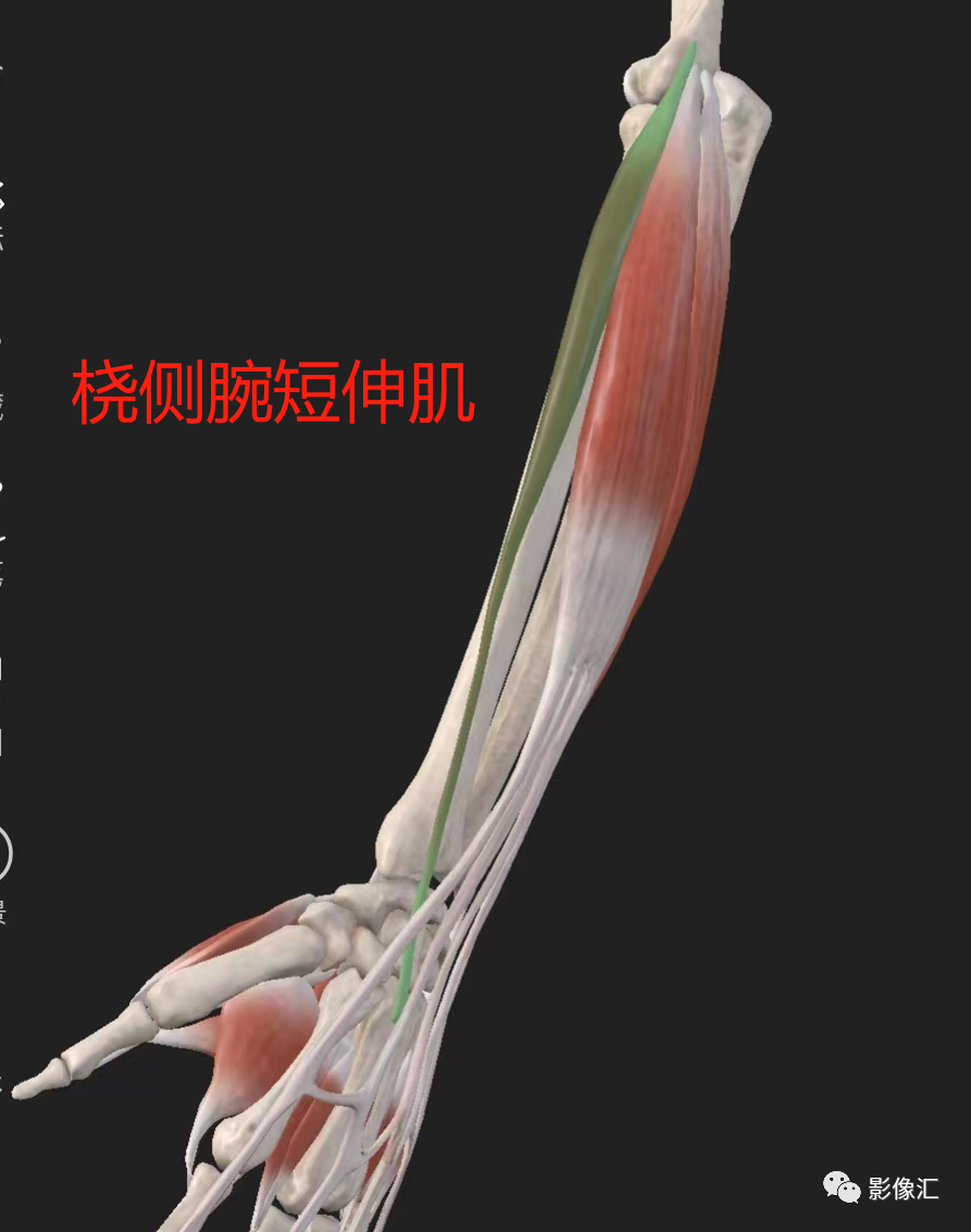 影像PPT - 【病例】肱骨外上髁炎1例MR影像详解-17 影像PPT - 【病例】肱骨外上髁炎1例MR影像详解-17