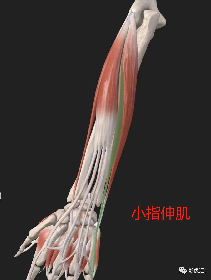 影像PPT - 【病例】肱骨外上髁炎1例MR影像详解-19 影像PPT - 【病例】肱骨外上髁炎1例MR影像详解-19