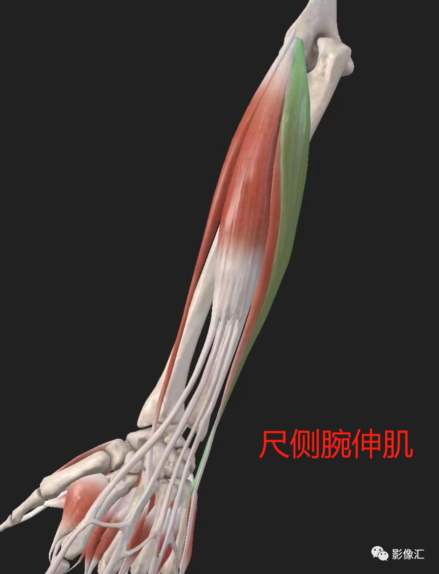 影像PPT - 【病例】肱骨外上髁炎1例MR影像详解-20 影像PPT - 【病例】肱骨外上髁炎1例MR影像详解-20