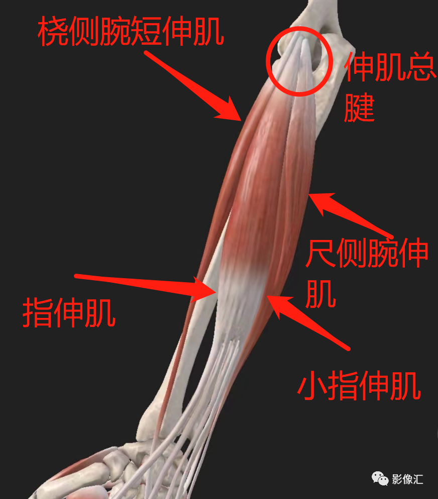 影像PPT - 【病例】肱骨外上髁炎1例MR影像详解-21 影像PPT - 【病例】肱骨外上髁炎1例MR影像详解-21