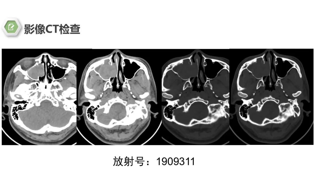 影像PPT - 【病例】鼻窦鼻腔出血坏死性鼻息肉1例CT及MR-4 影像PPT - 【病例】鼻窦鼻腔出血坏死性鼻息肉1例CT及MR-4