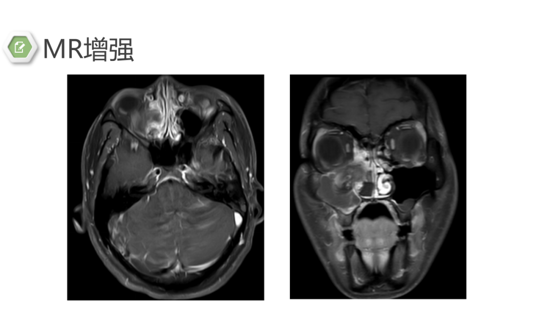 影像PPT - 【病例】鼻窦鼻腔出血坏死性鼻息肉1例CT及MR-7 影像PPT - 【病例】鼻窦鼻腔出血坏死性鼻息肉1例CT及MR-7