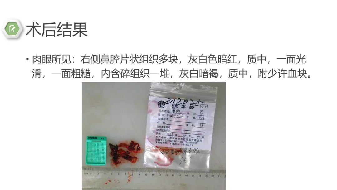 影像PPT - 【病例】鼻窦鼻腔出血坏死性鼻息肉1例CT及MR-9 影像PPT - 【病例】鼻窦鼻腔出血坏死性鼻息肉1例CT及MR-9