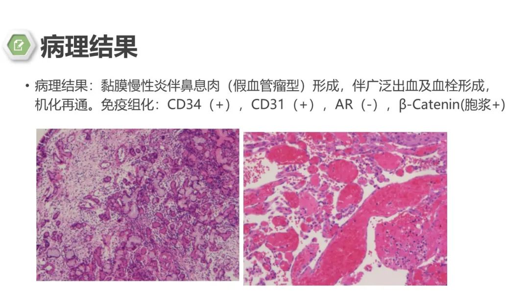 影像PPT - 【病例】鼻窦鼻腔出血坏死性鼻息肉1例CT及MR-10 影像PPT - 【病例】鼻窦鼻腔出血坏死性鼻息肉1例CT及MR-10