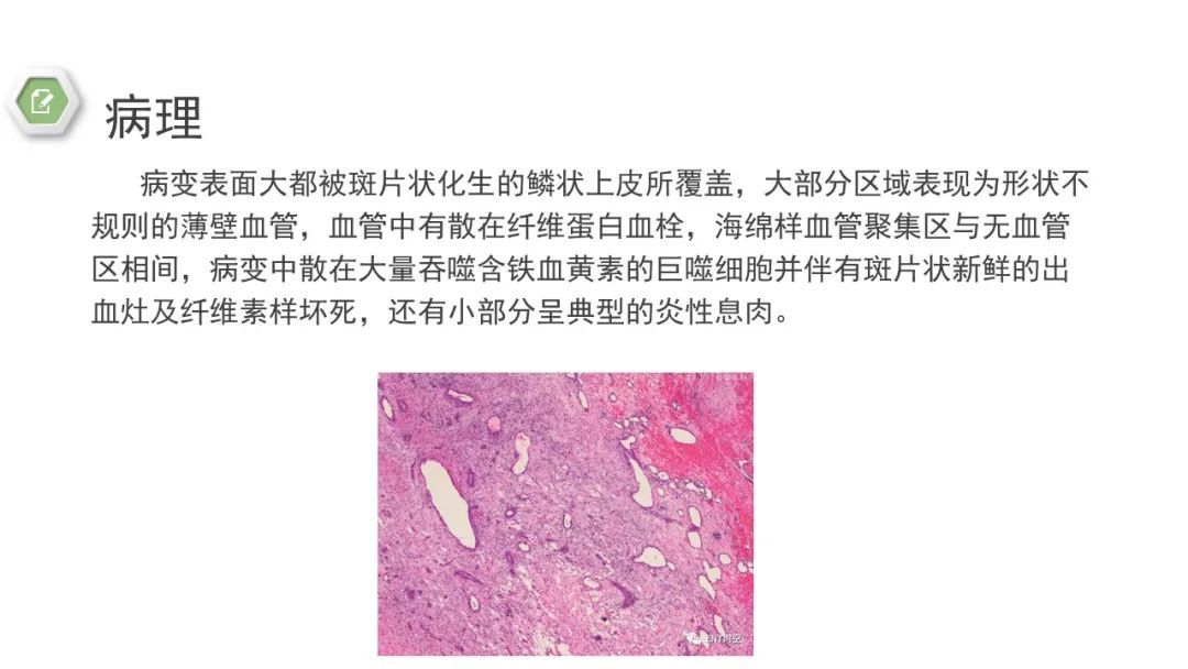 影像PPT - 【病例】鼻窦鼻腔出血坏死性鼻息肉1例CT及MR-13 影像PPT - 【病例】鼻窦鼻腔出血坏死性鼻息肉1例CT及MR-13