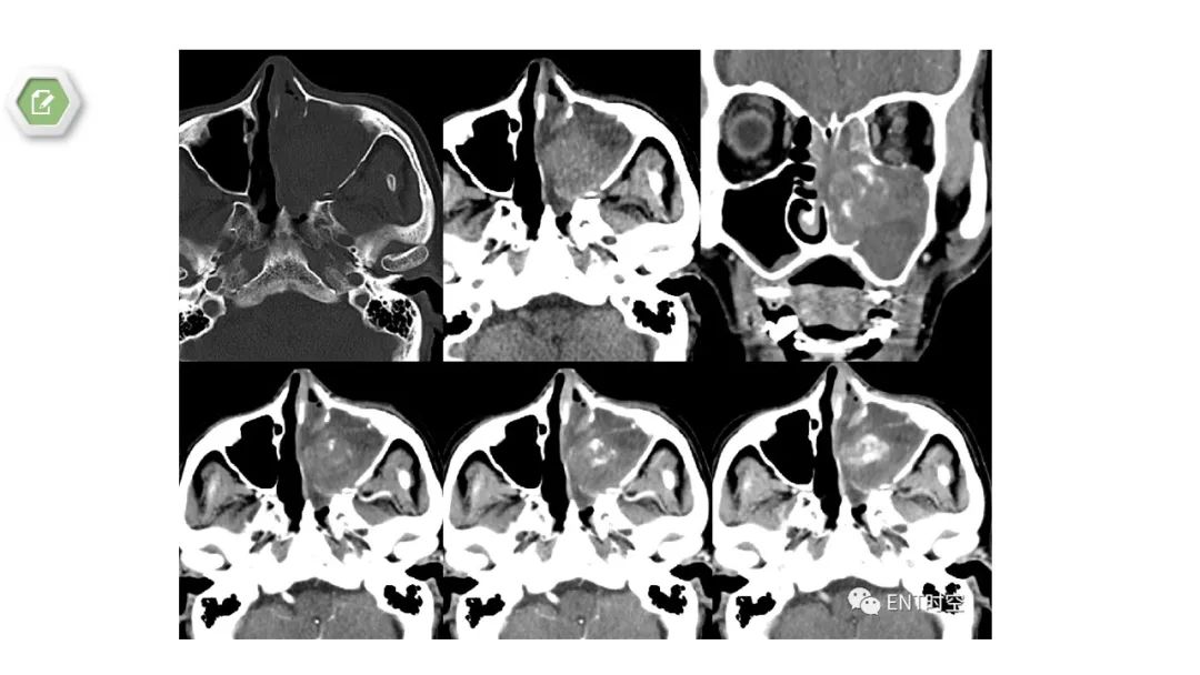 影像PPT - 【病例】鼻窦鼻腔出血坏死性鼻息肉1例CT及MR-15 影像PPT - 【病例】鼻窦鼻腔出血坏死性鼻息肉1例CT及MR-15