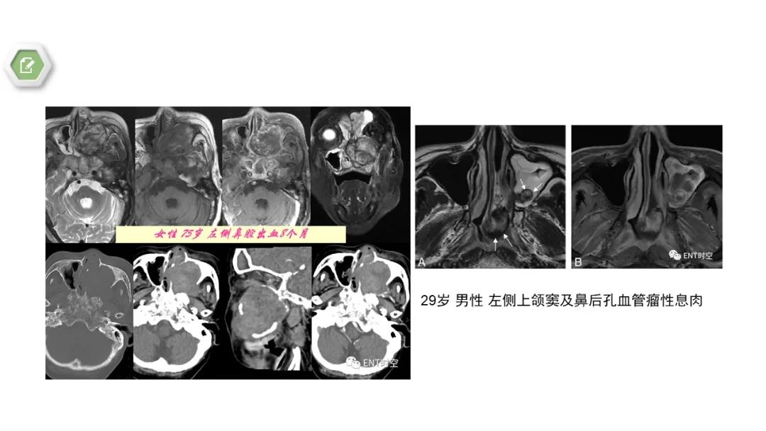影像PPT - 【病例】鼻窦鼻腔出血坏死性鼻息肉1例CT及MR-17 影像PPT - 【病例】鼻窦鼻腔出血坏死性鼻息肉1例CT及MR-17