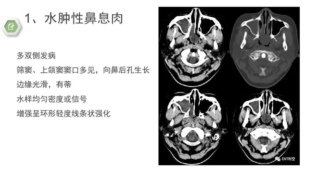 影像PPT - 【病例】鼻窦鼻腔出血坏死性鼻息肉1例CT及MR-19 影像PPT - 【病例】鼻窦鼻腔出血坏死性鼻息肉1例CT及MR-19