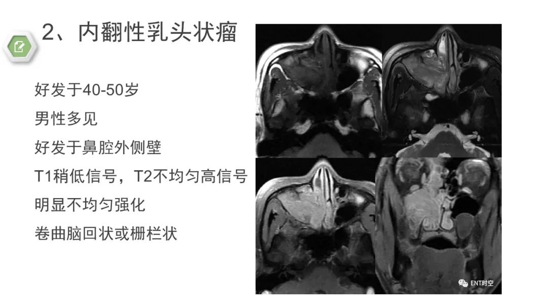 影像PPT - 【病例】鼻窦鼻腔出血坏死性鼻息肉1例CT及MR-20 影像PPT - 【病例】鼻窦鼻腔出血坏死性鼻息肉1例CT及MR-20