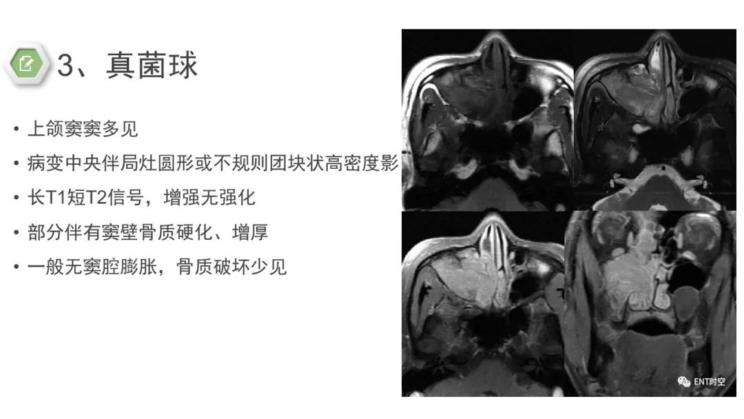 影像PPT - 【病例】鼻窦鼻腔出血坏死性鼻息肉1例CT及MR-21 影像PPT - 【病例】鼻窦鼻腔出血坏死性鼻息肉1例CT及MR-21