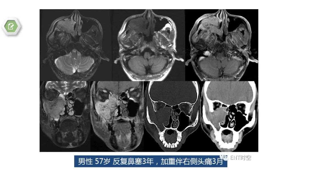 影像PPT - 【病例】鼻窦鼻腔出血坏死性鼻息肉1例CT及MR-23 影像PPT - 【病例】鼻窦鼻腔出血坏死性鼻息肉1例CT及MR-23