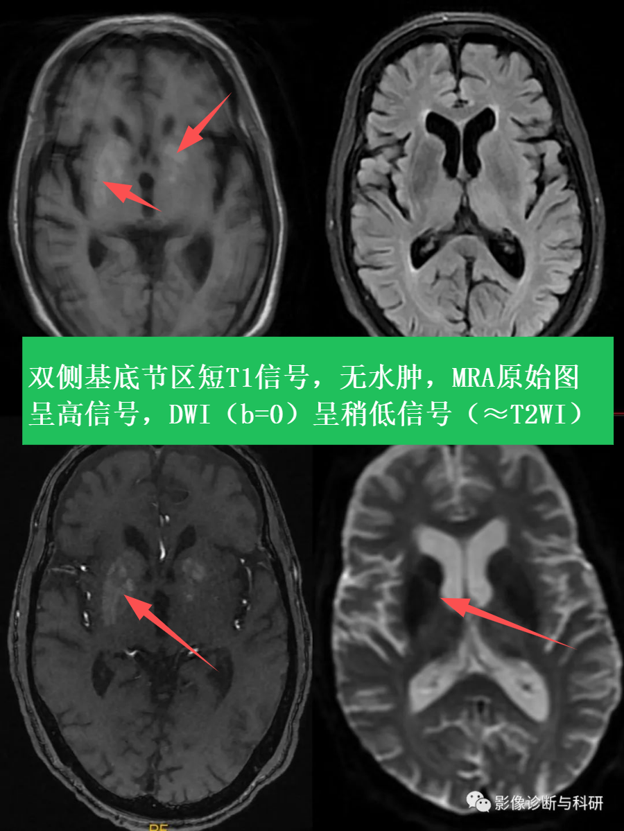 影像PPT - 【病例】糖尿病纹状体病(非酮性高血糖性偏身舞蹈症)1例-2