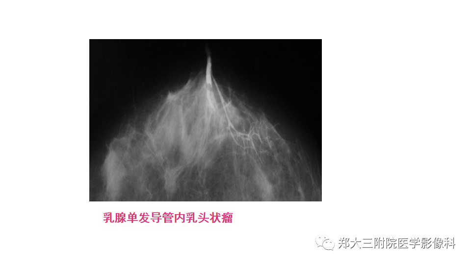 影像PPT - 【PPT】乳腺X线BI-RADS分类解读及常见病X线诊断-13
