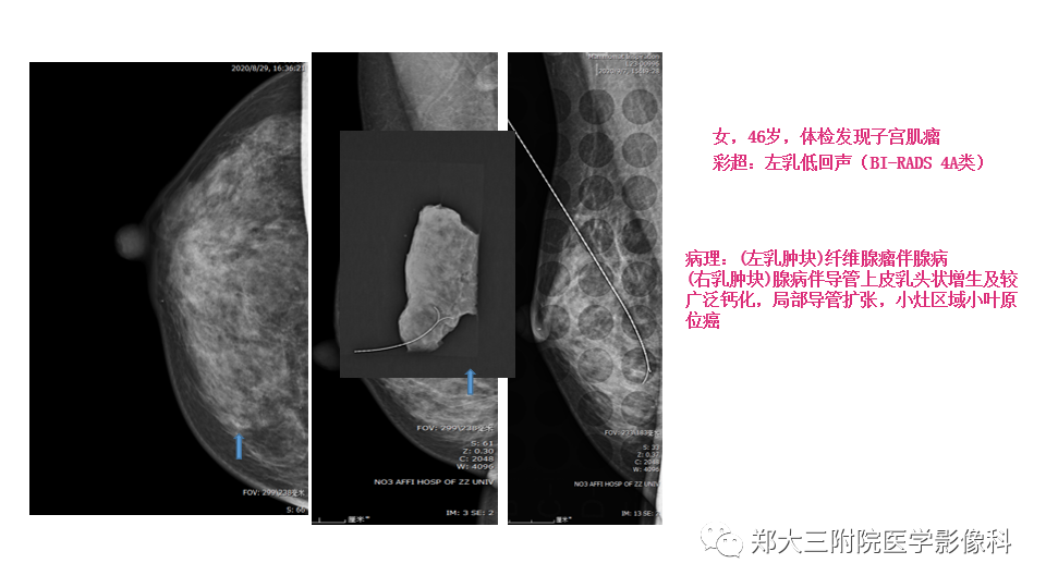 影像PPT - 【PPT】乳腺X线BI-RADS分类解读及常见病X线诊断-15