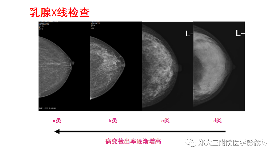 影像PPT - 【PPT】乳腺X线BI-RADS分类解读及常见病X线诊断-23