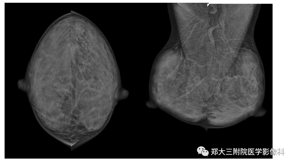 影像PPT - 【PPT】乳腺X线BI-RADS分类解读及常见病X线诊断-25