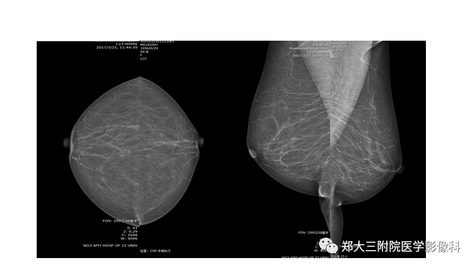 影像PPT - 【PPT】乳腺X线BI-RADS分类解读及常见病X线诊断-27